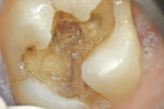 Figure 1  Patient’s chief complaint was of sensitivity upon chewing pressure. Note the crack along the pulpal floor.
