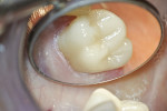 Figure 4  Final CEREC-fabricated porcelain restoration (Sirona Dental Systems, http://www.sirona.com).