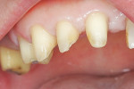 Figure 5  The original tooth.