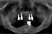 Fig 4. Preoperative CT scan with reconstructed panoramic radiograph showing severe bilateral ridge resorption posterior to the mental foramina.