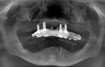 Fig 6. New CT scan reconstructed panoramic radiograph with surgical stent/scanning appliance. The surgical stent was used to determine the position of the distal implants and anterior/posterior (A/P) spread. Gutta-percha points were used to help visualize tooth position and location of mental foramina. Posterior implants were tilted distally to help increase A/P to align immediate-load overdenture with opposing maxillary overdenture.