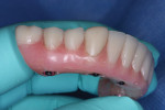Fig 13. Lateral view of the overdenture final contours. New black processing balls were re-placed before try-in of the overdenture after final recontouring and polishing. The overdenture with black processing balls was then tried in, and occlusion was checked and adjusted.