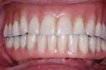Fig 15. Overdenture inserted after inclusion of high-retention green balls in denture attachment housings.