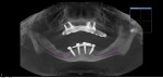 Fig 16. Postoperative CT scan with reconstructed panoramic radiograph demonstrating tapered 12-degree posterior implants angled to improve overall A/P spread, and tapered anterior implants.