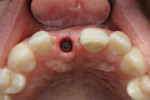 Fig 3. Note the palatal position of the implant fixture. The cover screw was accessed by perforating the gingiva using a coarse diamond bur. The opening was minimally enlarged to remove the cover screw, remaining palatal to the platform. A healing abutment was used to push the soft tissues facially.