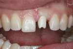 Fig 7. After a month, the hybrid zirconia custom abutment was tried in. The gingival architecture was reestablished with the provisional, and the prosthetic margins of the hybrid abutment supported the papillae. The abutment and porcelain-layered zirconia crown were treated with Z-Prime Plus.