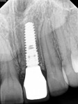 Fig 12. The final radiograph verified that all interproximal cement had been removed and served as a baseline to measure the rate of future bone loss. The radiograph also demonstrated excellent adaptation of
the custom hybrid abutment to the implant
platform and of the crown to the abutment.