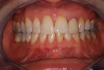 Fig 1. The patient presented complaining of a dark tooth in her lower arch that was “ugly” and “keeps me from smiling,” she said. After a full examination, clinical radiographs, and a sequence of American Academy of Cosmetic Dentistry accreditation photographs, it was determined that a simple porcelain crown over the existing root canal-treated tooth, No. 24, would be a viable, esthetic solution.