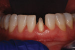 Fig 3. Tooth No. 24 was then prepared for a full crown with a lingual supragingival margin.
