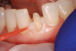 Fig 5. After cleansing with a 35% hydrogen peroxide formula (Superoxol, Sultan Healthcare, sultanhc.com) and expressing some impression material to bleed the cartridge and ensure proper mixing, a full-arch impression was taken using NoCord VPS. Retraction cord was not used, thereby avoiding gingiva trauma from the packing procedure.