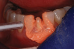 Fig 7. The author prefers the NoCord VPS impression kit from Centrix. NoCord VPS Wash material was syringed around the tooth and then air-blown before a second layer was added. This process fully covered the preparation, ensuring there was enough material to capture the complete margin.