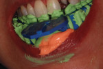 Fig 8. The tray was filled with NoCord VPS
MegaBody tray material then placed over the preparation, driving the wash into the sulcus and creating the space necessary to capture complete marginal detail. The impression was removed from the mouth at 4:45 minutes.