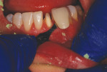 Fig 10. Final shade was taken of the prepared tooth. Note how healthy the tissue looked, as there was no trauma or reddened or impacted gingival tissue. Further, even with an endodontically treated tooth, no anesthetic was needed for any portion of the procedure, an added benefit for the patient and staff.