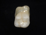 Fig 3. During the provisional phase of treatment, the patient reported no sensitivity. At the delivery visit 3 weeks later, the provisional restoration was removed from the prepared tooth and the surface of the preparation was
disinfected and cleaned with 2% chlorhexidine (eg, Cavity Cleanser™, Bisco, Inc., bisco.com; or Concepsis®, Ultradent Products, Inc., ultradent.com) to ensure a clean surface to cement to. The milled zirconium restoration is shown here.