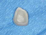 Fig 4. Intaglio view of the milled zirconium restoration, which was then tried on the preparation.
