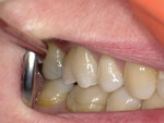 Fig 8. Final set time was about 5 minutes, as this is a self-curing cement with no resin included in the calcium alumina formulation. The cemented definitive restoration of tooth No. 3 is shown here.