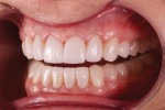 Fig 7 through Fig 9. With adequate reduction, the laboratory could fabricate beautiful restorations that also provided the patient with a stable occlusion to prevent further breakdown.