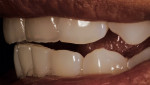 Fig 7. April 2014: Based on kinesiographic
studies of the patient’s functional movement, it was determined that the breakage occurred in phonetics and postural movements, continuing more in the anterior teeth from the lingual area, confirming a dysfunctional pattern.