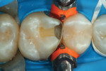 Fig 2. The tooth was prepared, including removal of proximal decay, and then a sectional matrix was placed (ComposiTight® 3D, Garrison Dental Solutions, garrisondental.com)
on the mesial aspect.
