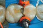Fig 3 and Fig 4. For this case, a 7th generation bonding resin (BeautiBond™, Shofu Dental) was utilized for the adhesive step; the preparation first was etched for 15 seconds, rinsed, and then dried.
