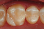 Fig 10. An occlusal view of the completed Class II composite restoration.