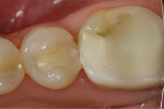 Fig 1. Preoperative photograph showed the washed-out filling on tooth No. 20 and the wear of the margin of tooth No. 19 on the mesial-buccal and the buccal cusps.