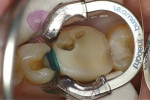Fig 4. The area was matrixed using a 3-dimensionally shaped Blue Cure-Thru® matrix band (Premier Dental, premusa.com) that was trimmed to allow proper tissue emergence profiles as well as filling in the buccal and lingual embrasures. Because of the thickness of the bands (0.075 mm thick), some separation of the teeth was necessary, so the Triodent® V4 (Ultradent Products) clear cure-through matrix ring and Triodent® wedges were used to seal the gingival margins of the Cure-Thru band strip to the tooth.