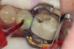 Fig 6. The bond resin, PQ1® (Ultradent Products), was delivered through an Inspiral® brush tip (Ultradent Products), and the area was flooded with bond resin and left for 30 seconds to penetrate the dentin to create a solid hybrid layer. The excess PQ1 resin was removed through a high-volume evacuator, the alcohol carrier was volatilized, and the area was polymerized for 10 seconds from the occlusal direction with a VALO® curing light (Ultradent Products).