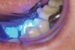 Fig 7. The filling material used for this case, Mosaic® universal nanohybrid composite (Ultradent Products), was placed using a bulk-fill technique and cured with a transdental polymerization process that the author has used for more than 30 years. After placement, the composite was cured through the tooth from both the buccal and lingual directions with the V4 ring in place. Light energy was activated for 20 seconds from the curing light from each buccal and lingual direction.