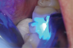 Fig 8. After the V4 ring was removed, the area was polymerized again from the buccal and lingual aspects for another 10 seconds from each direction per tooth restored to ensure that the light energy could reach the deepest recesses of the filling.