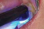 Fig 9. The final cure was done from the occlusal to prevent any polymerization shrinkage stresses at the pulpal floor of the preparations. The purpose of this last cure was to ensure that everything was fully polymerized because the light to that point had only been delivered from the buccal and lingual directions down by the gingival surface of the teeth.