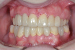Fig 5. Milled urethane provisionals on teeth Nos. 3 through 14 and 19 through 30. These provisionals functioned as blueprints for developing esthetics, function, and phonetics. Provisional cementation was accomplished by Integrity® TempGrip® Temporary Crown &
Bridge Cement (Dentsply Sirona).