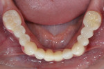 Fig 7. Mandibular view of milled provisionals on teeth Nos. 19 through 30.