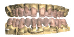 Fig 11. Scan of articulated models with proposed zirconia frameworks.