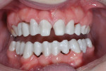 Fig 13. Try-in of frameworks on teeth Nos. 3 through 8, 9 through 14, and 19 through 30. Note the excellent tissue health and fit of the frameworks.