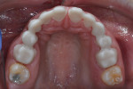 Fig 14. Maxillary view of frameworks on teeth Nos. 3 through 8 and 9 through 14.
