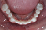 Fig 15. Mandibular view of frameworks on teeth Nos. 19 through 30.
