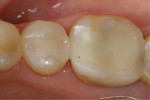 Fig 13. The final restorations satisfied the need for re-restoring tooth No. 20 and repairing tooth No. 19. The establishment of proper form, function, and esthetics was accomplished with minimal added trauma or stress to the patient’s dentition, allowing resolution of symptoms (occlusal and gingival food impaction) while still creating the proper contours to protect the tooth from occlusal forces. It is anticipated that the composite filling material used will enable the tooth to function well into the future.