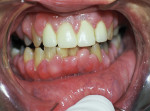 Gingival hyperplasia with increased pink,
fibrotic tissue.