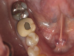 A 62-year-old healthy female presented with recurrent caries on tooth No. 30.