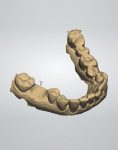 Tooth No. 30 was removed from the virtual model, and a virtual restoration was created.