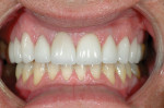 Figure 9: The final restorations closely matched the provisionals.