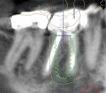 Identification of vital structures and osseous anatomy for virtual implant planning.