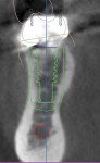 Identification of vital structures and osseous anatomy for virtual implant planning.