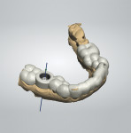 Creation of virtual fully-guided surgical template.
