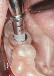 Guided placement of implant using 60 Ncm of torque.
