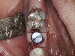 Placement of healing abutment and tissue stabilization using 3-0 chromic sutures