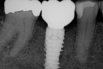 Ideally-placed implant creating a centric screw access and well-supported ceramics for long-term durability.