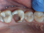 Preoperative intraoral view of tooth to be extracted.