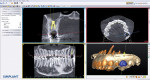 Implant placement using Simplant software